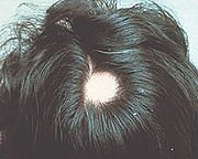 alopecia_areata